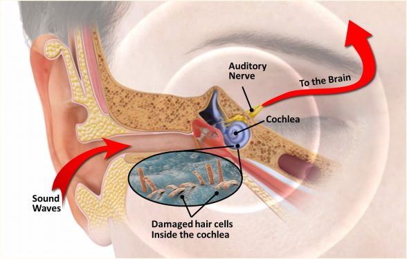 Middle on sale ear tinnitus