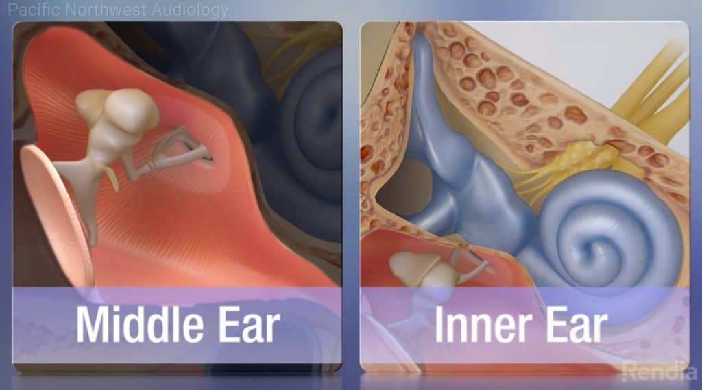 mixed-hearing-loss-pacific-northwest-audiology