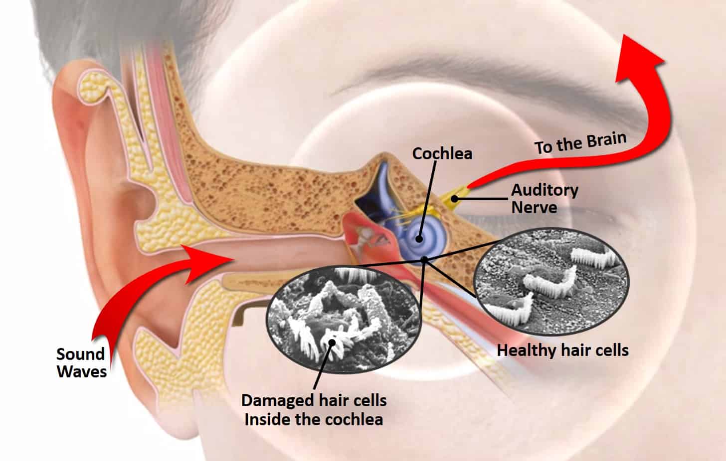 Noise Induced HEaring Loss